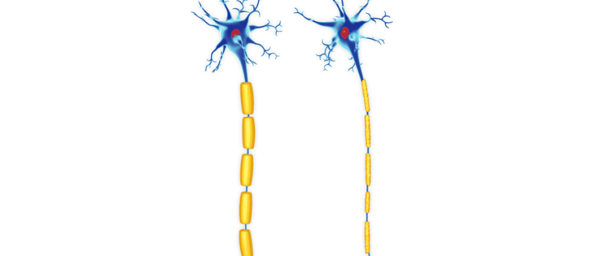 Nº1 CBD y la Esclerosis Múltiple