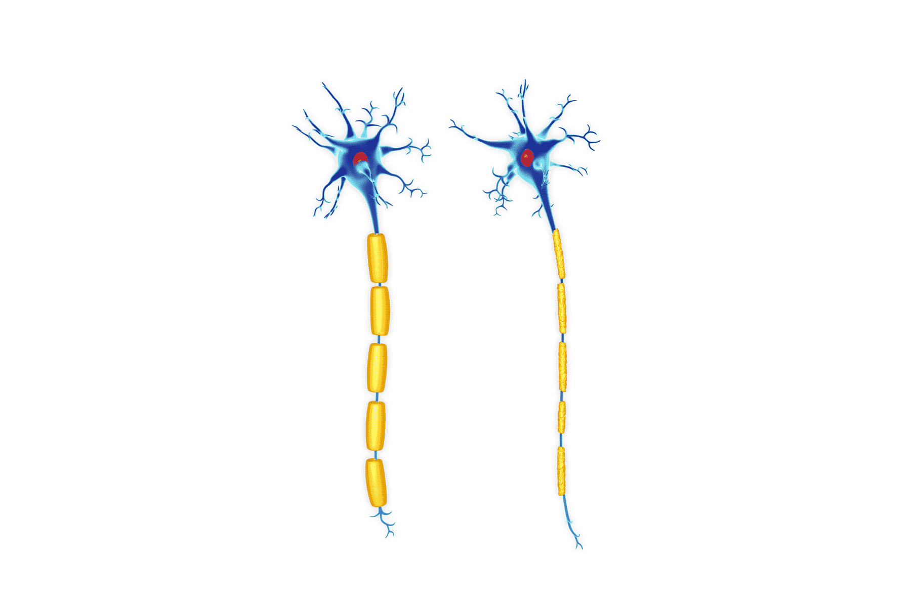 Nº1 CBD y la Esclerosis Múltiple